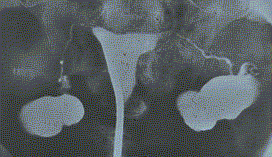 HSG showing fine fallopian tubes with spillage at fimbriae