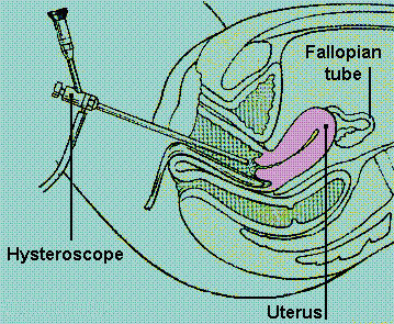 Hysteroscope graphic