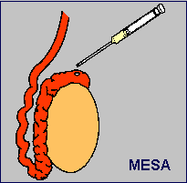 MESA - a comparatively lengthy surgical procedure to retrieve sperm - now replaced by PESA which can be done more simply and quickly.