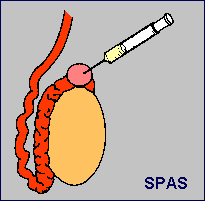 Sucking sperm from spermatocel (swelling)
