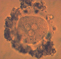 Three pronuclei resulting from two sperm simulataneously fertilising the egg - these embryos cannot develop normally as they have an extra set (23) chromosomes